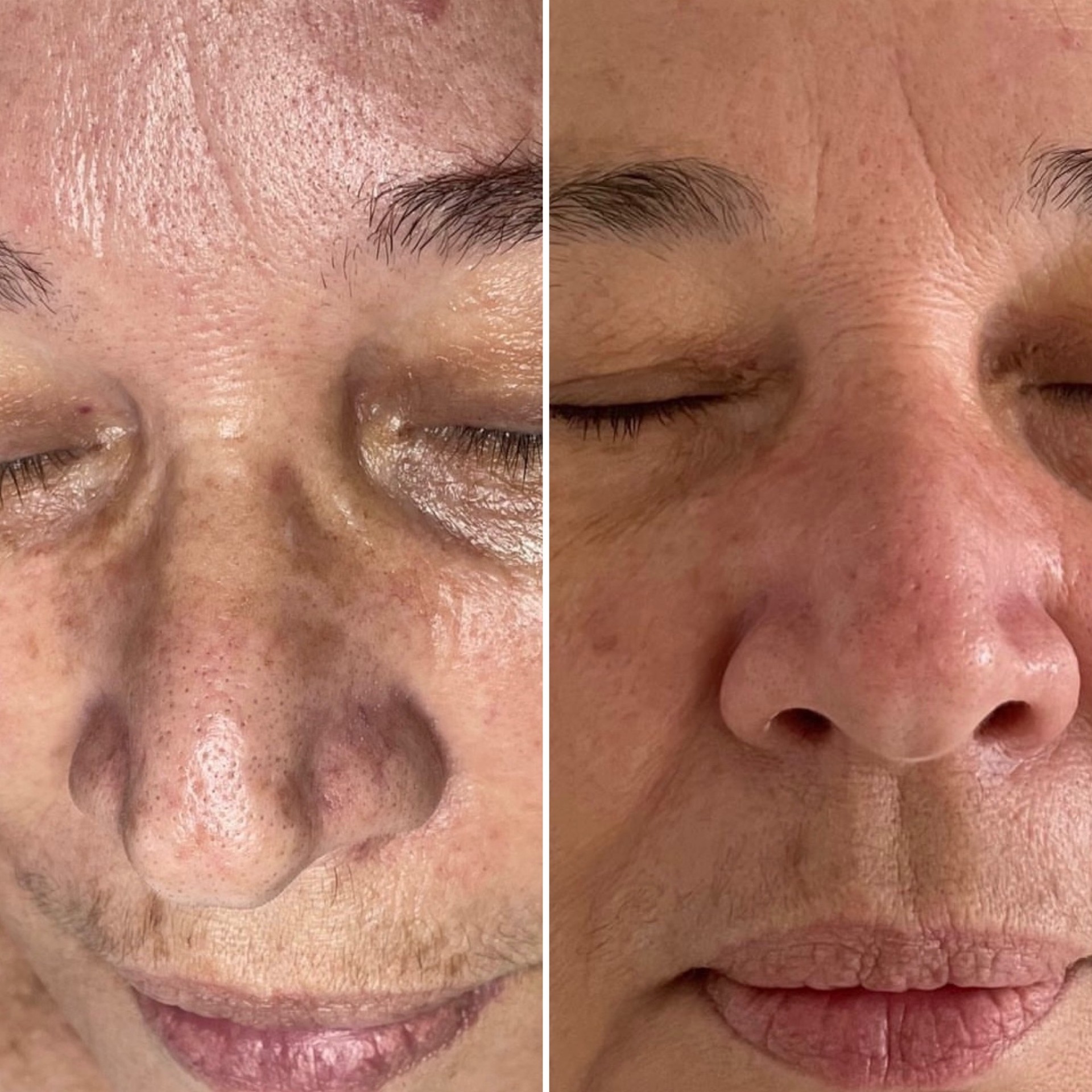 Before and after treatment result 1