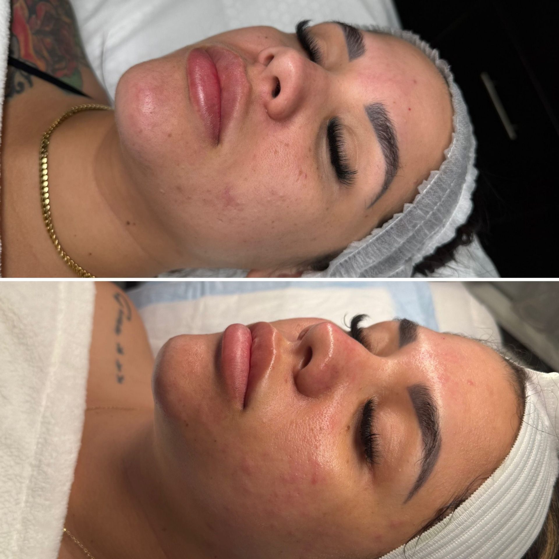 Before and after treatment result 4