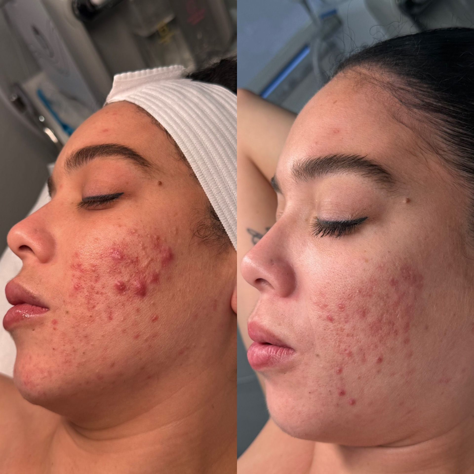Before and after treatment result 5